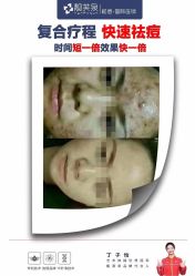 -靓芙泉专研痘痘肌