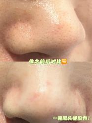 -凡碧诗毛孔清洁收细
