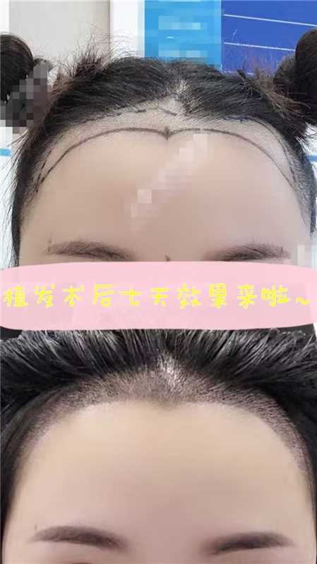 想去植发又怕疼(想去植发又怕疼怎么回事)