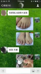 -德哥灰指甲脚气甲沟炎跖疣护理