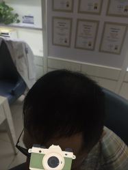 体验后-大麦微针植发丨全国连锁