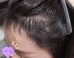 -大麦微针植发丨全国连锁