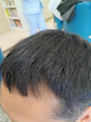 -碧莲盛·不剃发植发