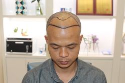 -大麦微针植发丨全国连锁