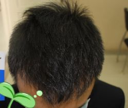 -大麦微针植发丨全国连锁