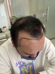 -大麦微针植发丨全国连锁