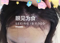 -大麦微针植发全国连锁