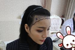 -大麦微针植发丨全国连锁