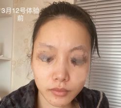 体验前-杭州米兰柏羽医疗美容医院