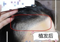 -大麦微针植发全国连锁