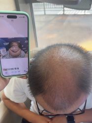 -碧莲盛·不剃发植发