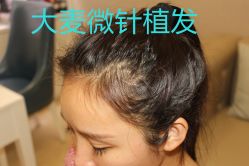 -大麦微针植发丨全国连锁