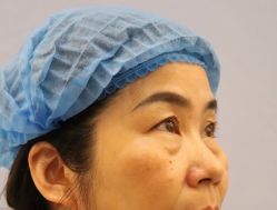 -天津健丽·去眼袋医疗美容机构