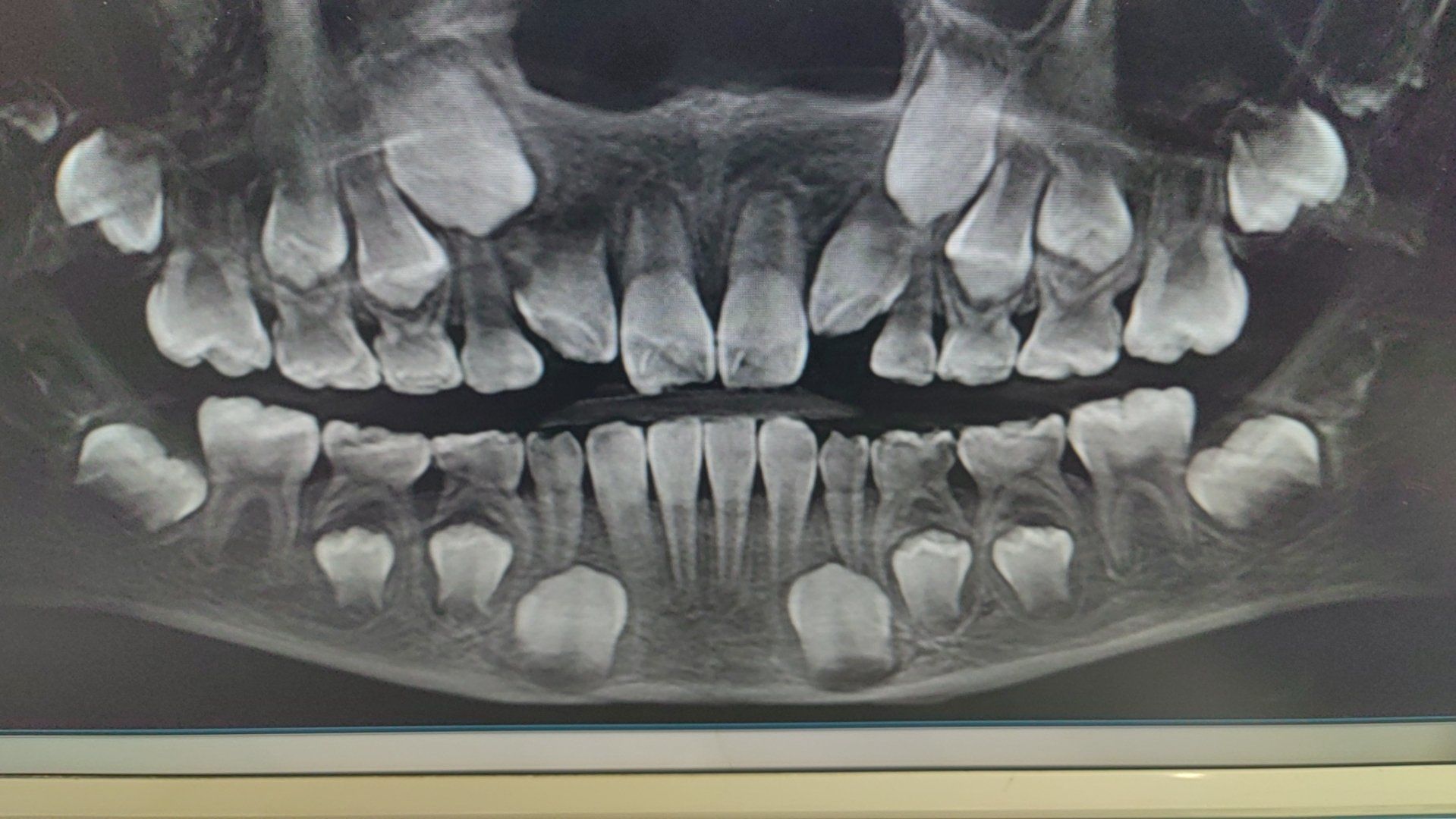 12岁,建议拍张片子看一看