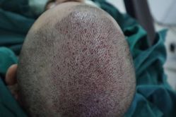 -大麦微针植发全国连锁