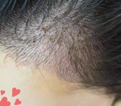 -大麦微针植发丨全国连锁