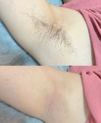 -薇兰专业脱毛连锁机构