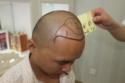 -大麦微针植发丨全国连锁