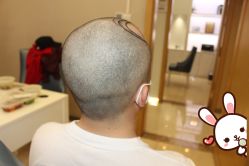 -大麦微针植发丨全国连锁