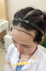-大麦微针植发全国连锁