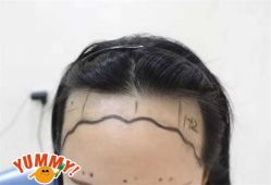 -大麦微针植发全国连锁