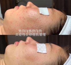 -美肤盾祛痘·问题肌头疗管理中心