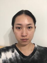 体验前-丰联丽格医疗美容·联合丽格眼整形中心