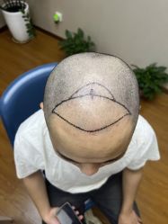 -大麦微针植发全国连锁