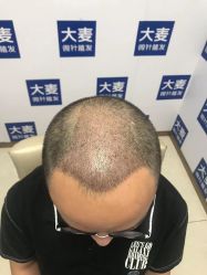 -大麦微针植发丨全国连锁