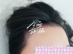 -大麦微针植发全国连锁