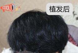 -大麦微针植发全国连锁
