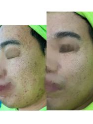 -苗医生0感祛痘连锁