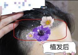 -大麦微针植发全国连锁