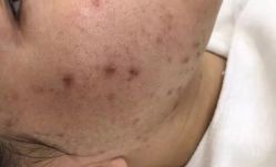 体验前-悟空祛痘·诺奖技术专业店