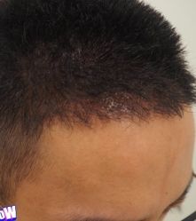 -大麦微针植发丨全国连锁