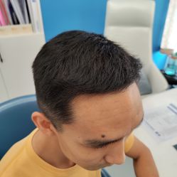 体验后-大麦微针植发全国连锁