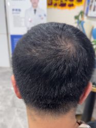 -碧莲盛·不剃发植发