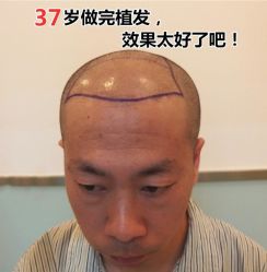 -碧莲盛·不剃发植发