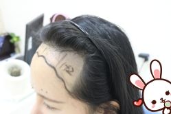 点击看大图 -大麦微针植发丨全国连锁