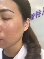 -蕾特恩专业祛痘国际连锁