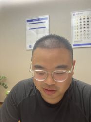 体验后-大麦微针植发全国连锁