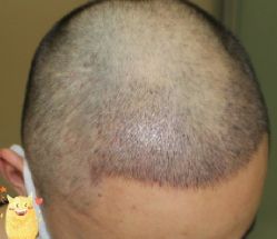 -大麦微针植发丨全国连锁