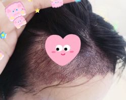 -大麦微针植发全国连锁