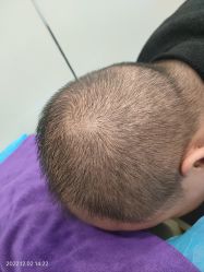 -碧莲盛·不剃发植发