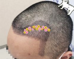 -大麦微针植发全国连锁