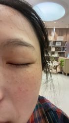 体验后-Yestar宁波艺星整形医院