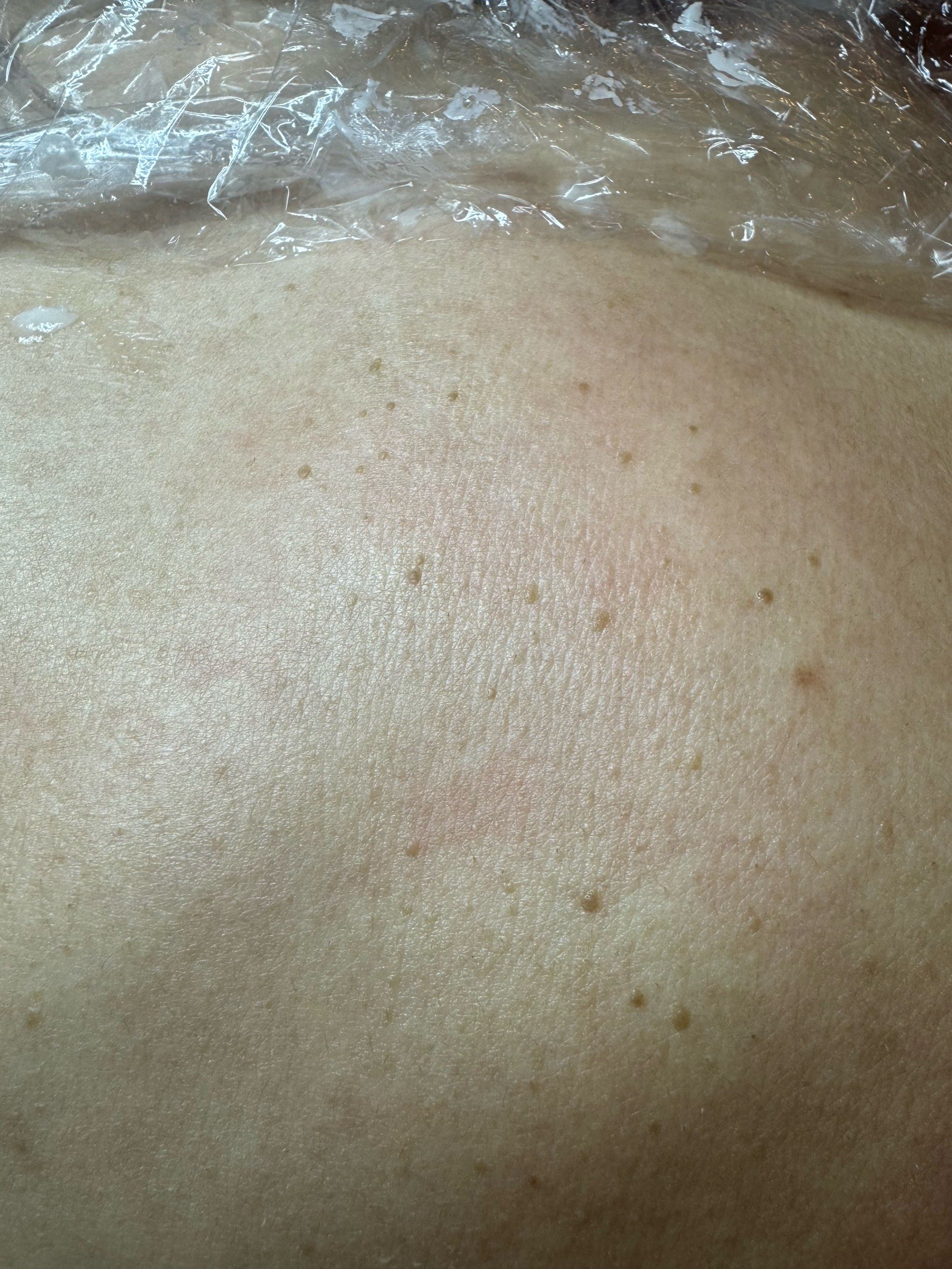 这扁平疣啊,发现后要及时弄掉,不是是真让