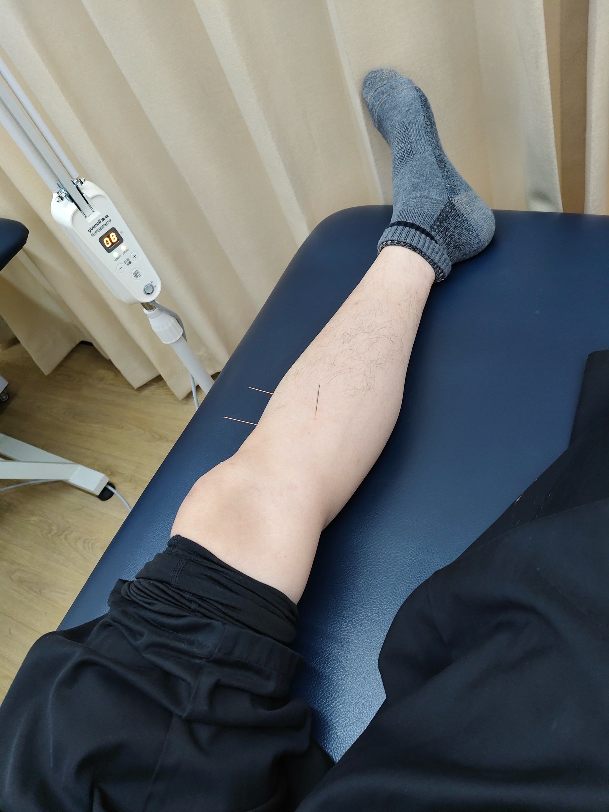 针灸治疗后,腿部酸胀感减轻许多