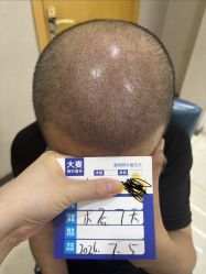-大麦微针植发丨全国连锁