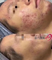 -苗方清颜专业祛痘·皮肤管理